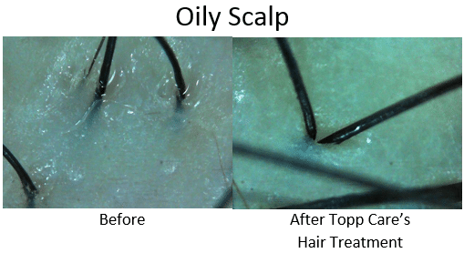 Oily Scalp Before After scalp images